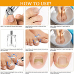 Load image into Gallery viewer, Professional Ingrown Nail Corrector Set
