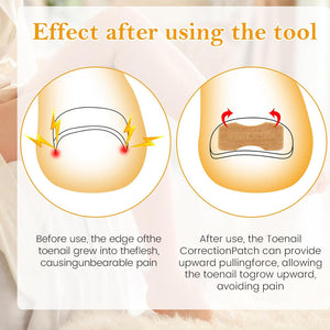Professional Ingrown Nail Corrector Set