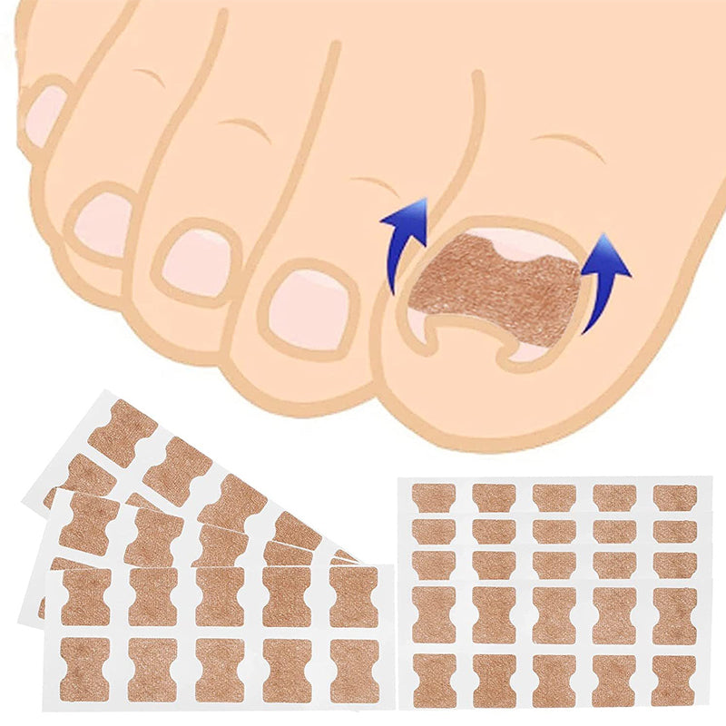 Professional Ingrown Nail Corrector Set